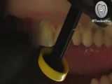 لمینت دندان | دندانستان 