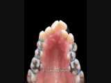 گسترش عرضی قوس فک بالا | دندانستان 