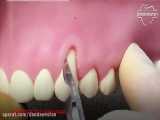 جراحی لثه | دندانستان