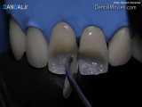 ترمیم مستقیم دندان قدامی - مرحله به مرحله 