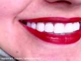 الو دکتر- اصلاح طرح لبخند در کلینیک دندانپزشکی فرجام