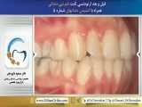 ارتودنسی ثابت نامرتبی دندانی | دندانستان 