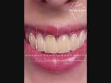 اصلاح طرح لبخند | دندانستان 