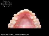 درمان تنگی فک بالا با استفاده از سیستم دیمون | دندانستان