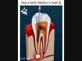 درمان ریشه-دکترمجیدقیاسی دندانپزشک زیبایی مشهد 