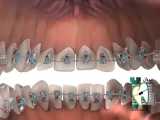 ارتودنسی لینگوال (زبانی) | کلینیک دندانپزشکی ایده آل 