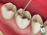 پرکردن دندان با آمالگام (مواد نقره ای) | کلینیک دندانپزشکی ایده آل 