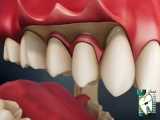دیپ اسکیلینگ ( Deep Scaling ) چیست؟ | کلینیک دندانپزشکی ایده آل 