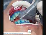فیلم توضیحات بلیچینگ دندان با لیزر از زبان دکتر سجودی 