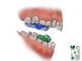 دستگاه فانکشنال | کلینیک دندانپزشکی ایده آل 