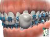 موم ارتودنسی | کلینیک دندانپزشکی ایده آل 