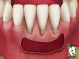 پیوند لثه | کلینیک دندانپزشکی ایده آل 