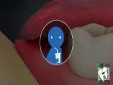 جراحی دندان عقل | کلینیک دندانپزشکی ایده آل 
