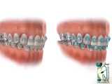 انواع مختلف براکت های ارتودنسی | کلینیک دندانپزشکی ایده آل 