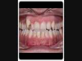 درمان ارتودنسی بدون جراحی فک و بدون کشیدن دندان | دکتر قریشی 