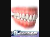 درمان دندان فاصله  دار 
