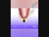 جراحی سینوس لیفت (بالا بردن سینوس ) جهت قراردادن ایمپلنت دندان 