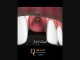 مهم‌ترین مزیت‌های ایمپلنت دندان 