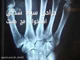 درنان جراحی سیاه شد استخوان مچ دست ( کین باخ) | دکتر دانیال شریفی | جراح دست
