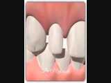 درمان  دندان های لترال کوچک | دکتر قریشی 
