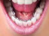 انواع درمان های ارتودنسی | کلینیک دندانپزشکی کانسپتا 