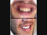 اصلاح طرح لبخند | دکتر حامد صالحی 