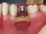 ایمپلنت (کاشت دندان) | دکتر صالحی 