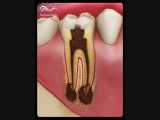 پوسیدگی های دندانی | دکتر حامد صالحی 