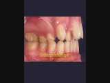 ارتودنسی با کشیدن دندان | دکتر سپیده دادگر 