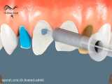 لمینیت دندان یا ونیر پرسلن | دکتر حامد صالحی