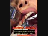 ایمپلنت دندان به روش پانچ 