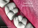 علت پوسیدگی زودرس دندان چیست؟