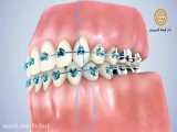 نخ دندان ارتودنسی | دکتر فرهاد گرجی