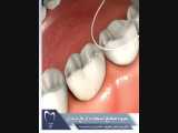 شیوه صحیح استفاده از نخ دندان | دکتر زینب رضایی اسفهرود 