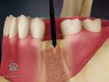ایمپلنت دندان | دکتر معصومه عطوفی 