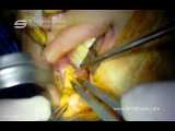 جراحی خارج کردن چربی بوکال (لپ) توسط دکتر شهریار یحیوی