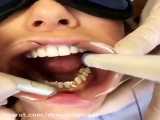 برداشت ونیر دندانی قدیمی با لیزر-دکترمجیدقیاسی-دندانپزشک زیبایی مشهد