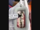 بلیچینگ دندان | دندانستان 