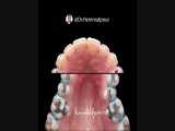 گسترش قوس دندانی فقط توسط ارتودنسی | دکتر سیامک همت پور 