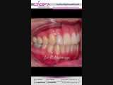 درمان ارتودنسی ثابت بدون کشیدن دندان | کلینیک کانسپتا 