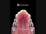 گسترش قوس دندانی فقط توسط ارتودنسی | دندانستان 