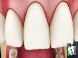 خطوط عمودی که در دندانهای جلویی | کلینیک دندانپزشکی ایده آل 