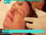 آموزش پاکسازی پوست | پاکسازی صورت ( نحوه استفاده از درمارولر )