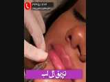 فیلر برای لب