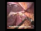 توتال گاسترکتومی(آناستوموز مری به روده با استاپلر) 