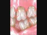 عوارض کشیدن دندان 