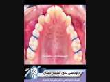 ارتودنسی بدون کشیدن دندان.متخصص ارتودنسی تهران.دکتر علیرضاخدیوی 
