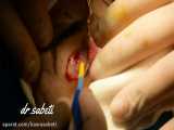 عمل جراحی پلک-جراحی بلفاروپلاستی