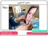 تزریق چربی به صورت