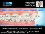 بستن فضاهای بین دندانی در ارتودنسی ثابت